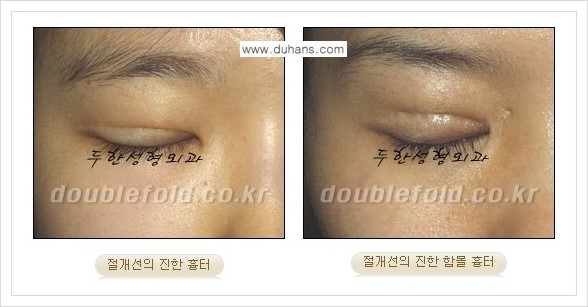 [두한성형외과 경쟁력 쌍꺼풀(눈) 재수술] - [쌍꺼풀 흉터선이 진한 경우의 안내] 관련 이미지 1