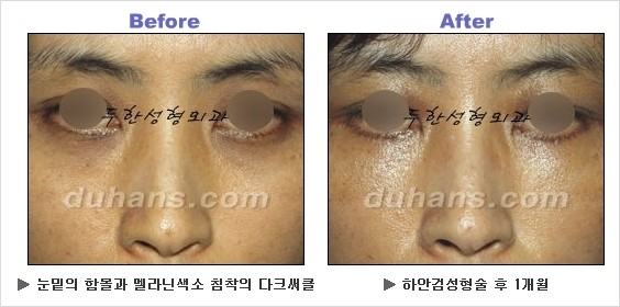 [두한성형외과 경쟁력 동안성형 리더] - ​[미간주름, 이마주름, 안검성형, 이마거상술, 눈썹거상술] 관련 이미지 120