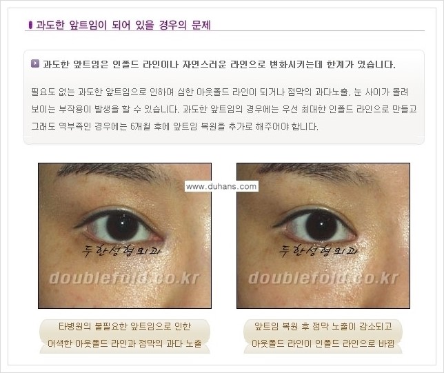 [두한성형외과 경쟁력 쌍꺼풀 재수술(극한 재수술)] - [쌍꺼풀 재수술에서 극복해야 할 여러 가지 상황과 문제점들 안내] 관련 이미지 5