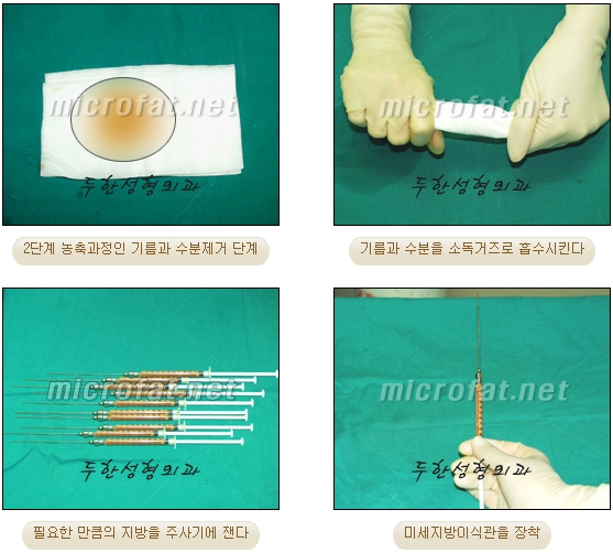 얼굴지방이식 두한성형외과 - 볼지방이식 관련 이미지 8