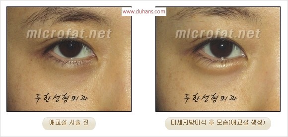​﻿[두한성형외과 경쟁력 지방이식] - [눈밑 애교살 시술을 위한 미세지방이식] 관련 이미지 9