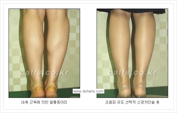 [두한성형외과의 경쟁력 멀티 종아리성형] - [근육퇴축을 위한 초음파 유도 선택적 신경차단술 안내] 관련 이미지 7