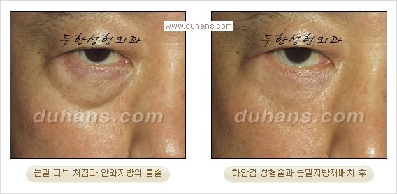 [두한성형외과 경쟁력 다크써클 교정] - [젊어 보이면서 개선된 인상을 주는 하안검 성형술] 관련 이미지 12