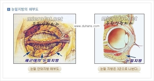 [두한성형외과 경쟁력 지방제거] - [눈밑(눈위)지방제거, 눈꺼풀(윗눈꺼풀)지방제거 안내 ①] 관련 이미지 4