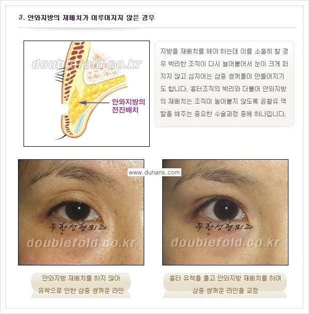[두한성형외과 경쟁력 쌍꺼풀 재수술, 극한 재수술] - [쌍꺼풀 재수술 실패 원인(Cause of reoperation fail) 안내] 관련 이미지 3
