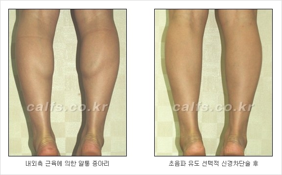 [두한성형외과 경쟁력 종아리성형] - [초음파 유도 선택적 신경차단술 안내 ④] 관련 이미지 5