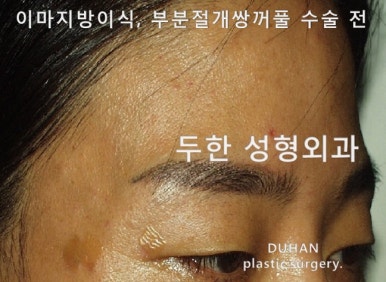 [Duhan Plastic Surgery Eye Surgery] - [Quick Double Eyelid Surgery] image 25