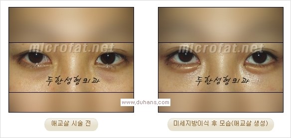 [두한성형외과 경쟁력 눈밑성형] - [타 병원 필러 애교살 시술 부작용을 미세지방이식으로 교정] 관련 이미지 19