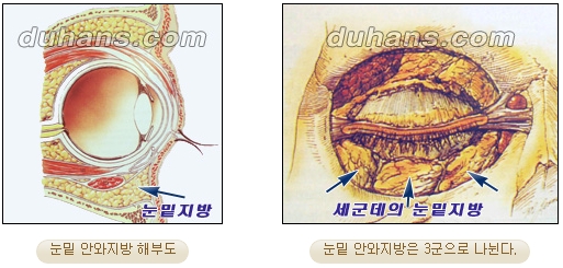 두한성형외과 지방제거 - 눈밑지방, 눈꺼풀지방제거 관련 이미지 12