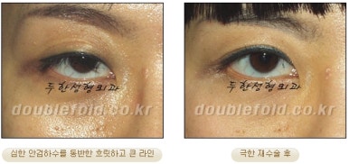 쌍꺼풀수술 두한성형외과 - 쌍커풀재수술의 문제점 관련 이미지 33