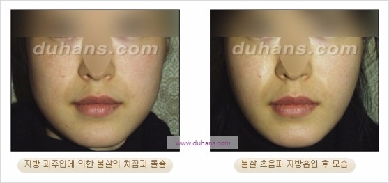 [두한성형외과 경쟁력 지방흡입] - [볼살, 턱선의 간편 지방흡입] 관련 이미지 19