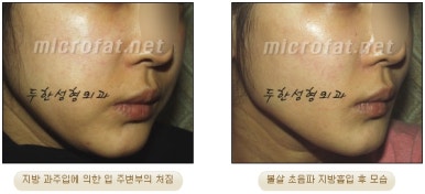 Facial Fat Liposuction at Duhan Plastic Surgery - Cheek Fat Liposuction, Jawline Liposuction, Under-Eye Fat Liposuction image 11