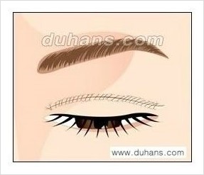 [두한성형외과 경쟁력 쌍꺼풀 재수술, 극한 눈재수술] - [쌍꺼풀 재수술, 눈재수술 실패의 원인 안내] 관련 이미지 7