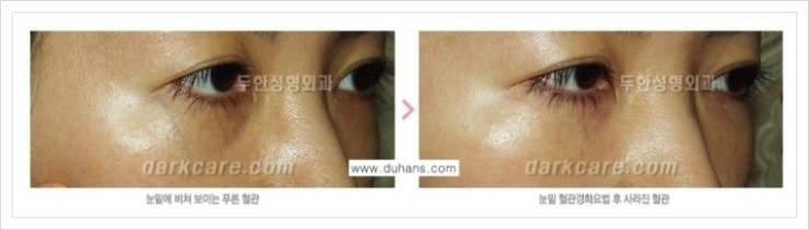 [두한성형외과 경쟁력 눈밑성형] - [눈밑 다크써클 증상과 그 증상에 맞는 치료 방법 안내] 관련 이미지 27