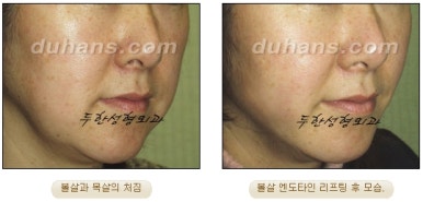 [Duhan Plastic Surgery Wrinkle Improvement] - [Wrinkle Lifting] image 22
