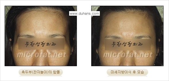 [두한성형외과 경쟁력 미세지방이식] - [관자놀이(측두부) 지방이식] 관련 이미지 10