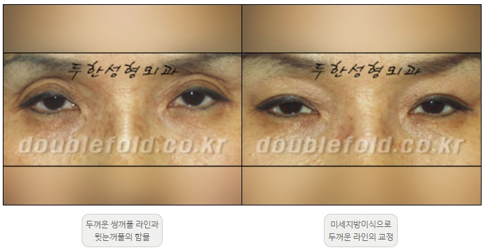 [Duhan Plastic Surgery Double Eyelid Revision] - [Thick Double Eyelid Line] image 22