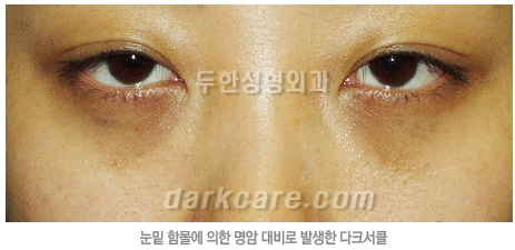 Duhan Plastic Surgery Dark Circle Improvement - What Causes Dark Circles? What Types of Dark Circles Are There? image 8