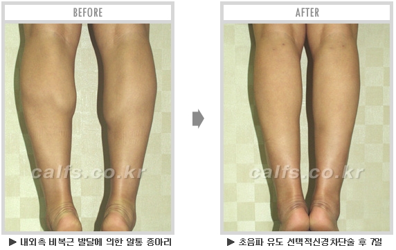 [종아리성형 두한성형외과] - [종아리수술에 대한 자주하는 질문과 답변 모음] 관련 이미지 57