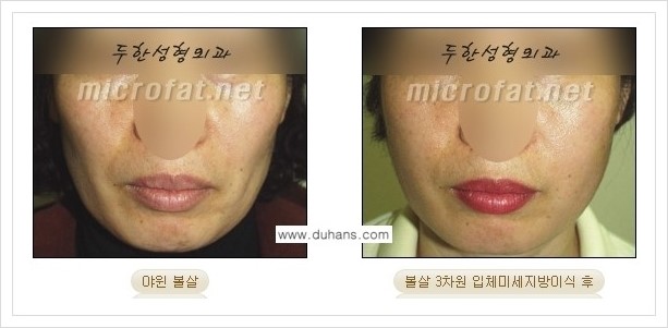 ⁠[두한성형외과 경쟁력 미세지방이식] - [상표등록 "Col-fat(콜펫) 지방이식"으로 교정이 가능한 부위] 관련 이미지 8