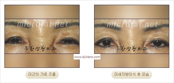 [두한성형외과 경쟁력 동안성형 리더] - ​[미간주름, 이마주름, 안검성형, 이마거상술, 눈썹거상술] 관련 이미지 15