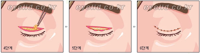 [두한성형외과 눈성형] - [쌍꺼풀수술의 절개법, 매몰법] 관련 이미지 3