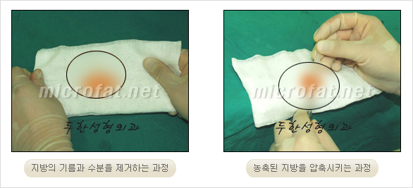 [두한성형외과 경쟁력 안티에이징 동안성형] - [주름이 깊은 푹~ 꺼진 입가 팔자주름 안녕!] 관련 이미지 12