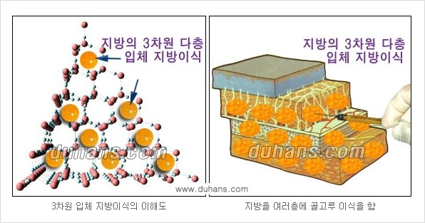 ⁠⁠[두한성형외과 경쟁력 미세지방이식] - [3차원 입체지방이식, 2차원 평면지방이식] 관련 이미지 2