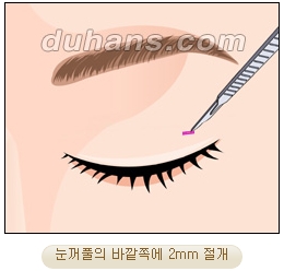 두한성형외과 지방제거 - 눈밑지방, 눈꺼풀지방제거 관련 이미지 5
