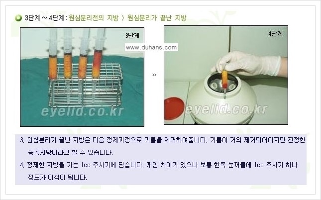 [두한성형외과 경쟁력 눈밑성형] - [다크써클 수술 안내 1.] 관련 이미지 7