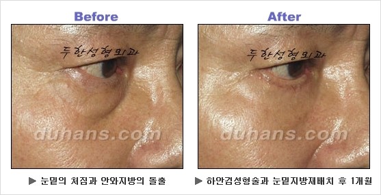 [두한성형외과 경쟁력 동안성형 리더] - ​[미간주름, 이마주름, 안검성형, 이마거상술, 눈썹거상술] 관련 이미지 79