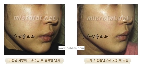 [두한성형외과 경쟁력 미세지방이식] - [타 병원에서 볼살 지방이식 이후 부작용 교정 방법 안내] 관련 이미지 10