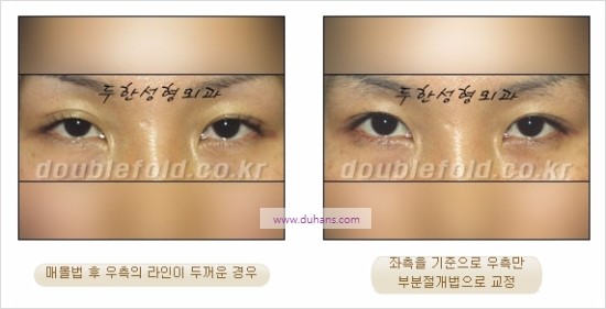 [두한성형외과 경쟁력 눈성형] - [비대칭 쌍꺼풀 라인의 여러 가지 교정 방법] 관련 이미지 4
