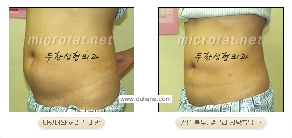 [두한성형외과 겨울엔 간편 지방흡입] - [복부, 뱃살, 아랫배, 옆구리 지방흡입 도전!] 관련 이미지 4