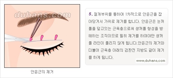 ​[두한성형외과 경쟁력 눈성형] - [자연스럽고 아름다운 쌍꺼풀의 기준] 관련 이미지 11