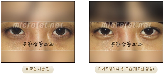 ​[두한성형외과 지방이식] - [애교살] 관련 이미지 13