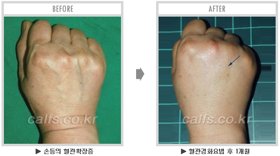 [종아리성형 두한성형외과] - [종아리수술에 대한 자주하는 질문과 답변 모음] 관련 이미지 31