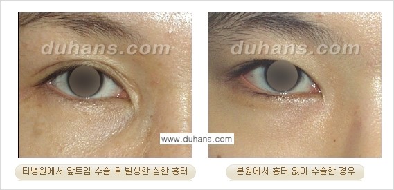 [두한성형외과 눈성형 FOCUS] - [몽고주름 제거(앞트임 제거) 수술 ①] 관련 이미지 5