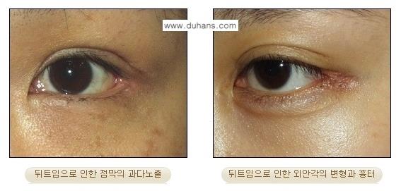 [두한성형외과 경쟁력 눈성형] - [뒤트임 수술 안내] 관련 이미지 2