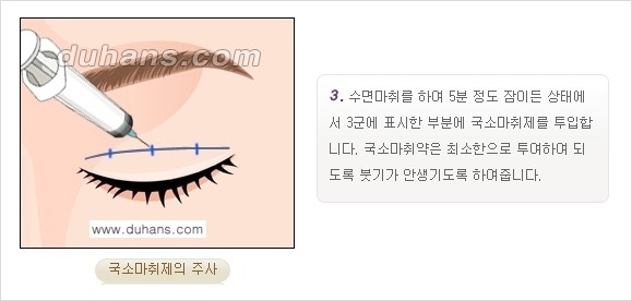 [두한성형외과 경쟁력 눈성형] - [쌍꺼풀 재수술 방법 - 부분절개법(Partial incision method) 과정 안내] 관련 이미지 4