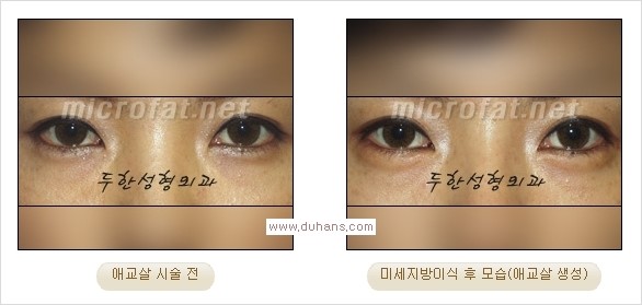 [두한성형외과 경쟁력 눈밑성형] - [타 병원 필러 애교살 시술 부작용을 미세지방이식으로 교정] 관련 이미지 15