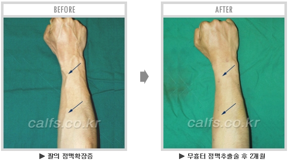 [종아리성형 두한성형외과] - [종아리수술에 대한 자주하는 질문과 답변 모음] 관련 이미지 49