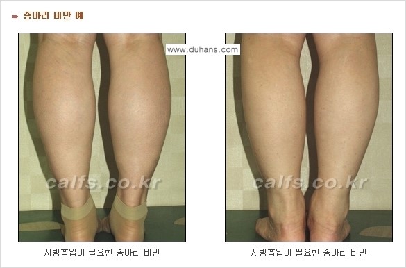 ⁠⁠⁠​[두한성형외과 경쟁력 멀티종아리 성형] - [정교한 미세흡입관 지방흡입술 안내 ①] 관련 이미지 2