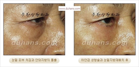 [두한성형외과 경쟁력 안검성형] - [눈밑주름 제거수술] 관련 이미지 9