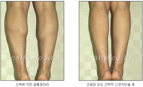 ​[두한성형외과 종아리성형] - [나에게 맞는 종아리시술] 관련 이미지 7