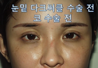 (눈밑지방이식&코 비개방 실리콘 삽입술)]-#낮은코 개선, 다크서클 개선 관련 이미지 1
