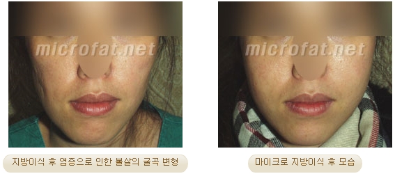 [두한성형외과 지방이식] - [타병원의 지방이식 부작용 교정] 관련 이미지 22