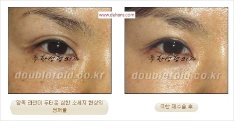 ​[두한성형외과 눈재수술] - [앞트임복원, 뒤트임복원, 쌍꺼풀복원] 관련 이미지 21