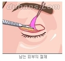 [두한성형외과 안검성형] - [상안검, 하안검] 관련 이미지 4