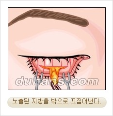 ⁠⁠[두한성형외과 경쟁력 안검성형] - [젊은 눈매를 위한 윗눈꺼풀 지방제거, 눈밑 지방제거] 관련 이미지 16